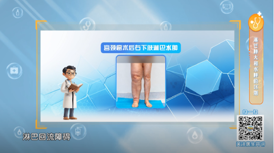 淋巴水肿